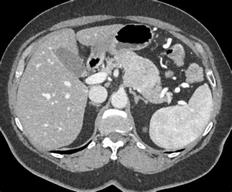 Neuroendocrine Tumor In The Tail Of The Pancreas Pancreas Case