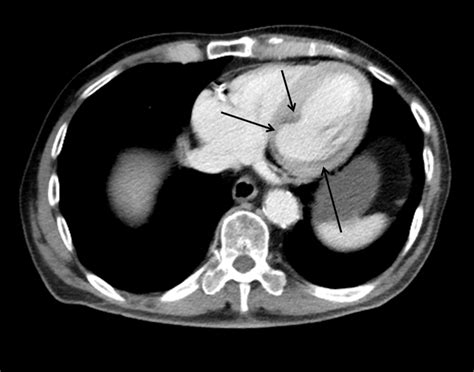 Dr. Smith's ECG Blog: A Picture of Subendocardial Ischemia