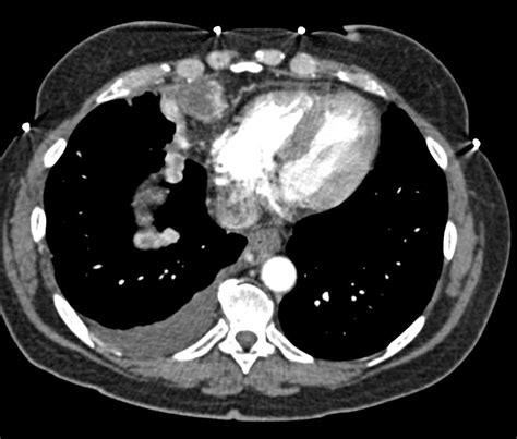 Metastatic Carcinoid Tumor With Vascular Implants Liver Case Studies