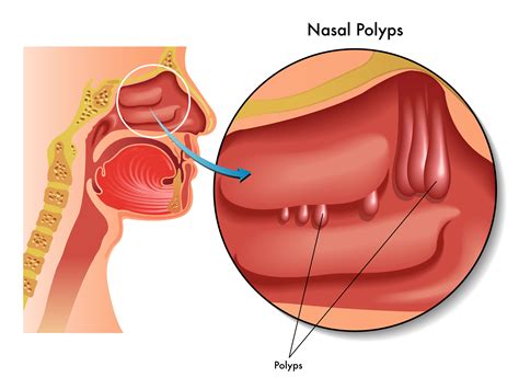 Nasal Polyps | Ireland| PDF | PPT| Case Reports | Symptoms | Treatment
