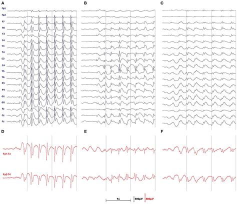 Frontiers Absence Seizure Detection Algorithm For Portable EEG Devices