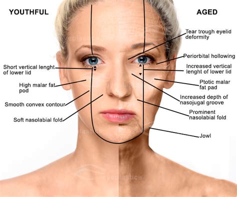 Mid Face Surgery Procedures Boise | Cheek Lift Idaho