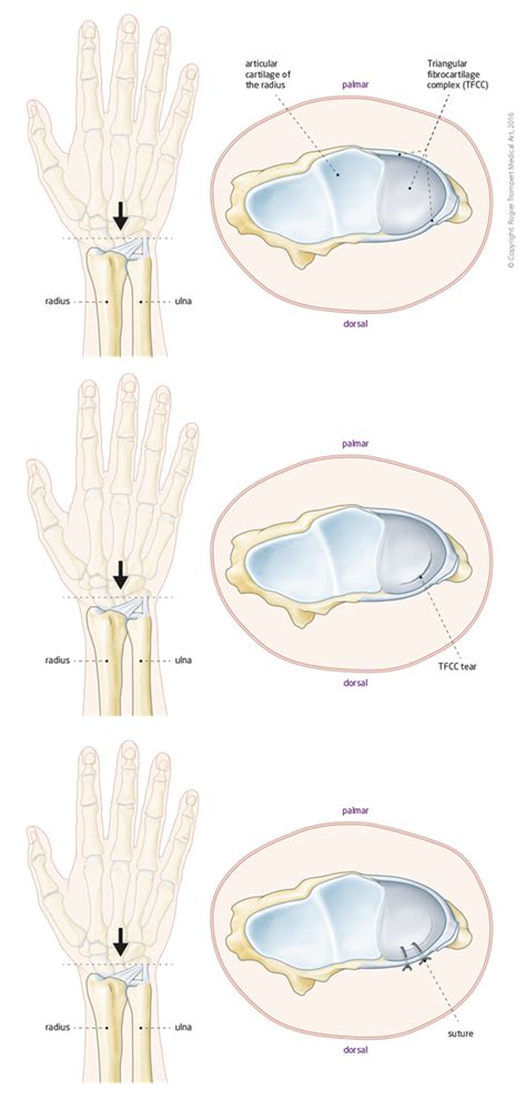 TFCC injury | Grip Hand & Wrist Surgery