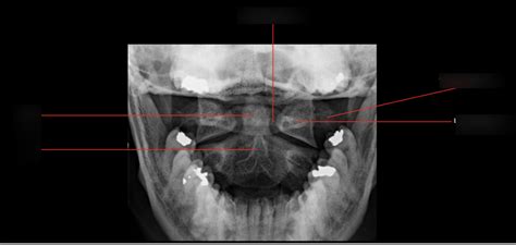 xray of back of spine Diagram | Quizlet