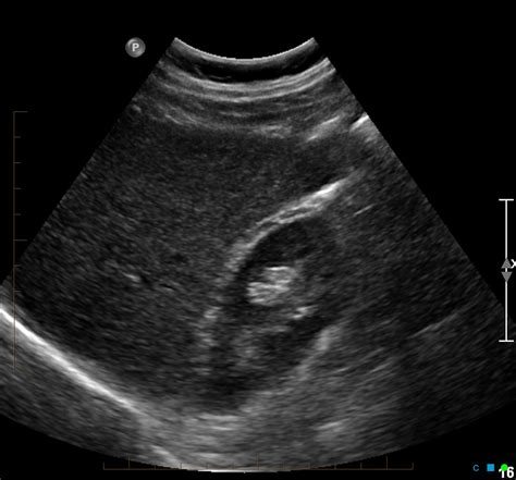 Normal Liver Ultrasound