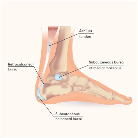 Achilles Bursitis Retrocalcaneal Bursitis (Heel Bursitis, 42% OFF