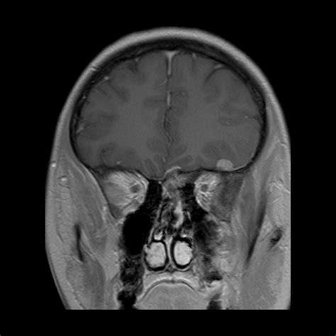 Pediatric Neurofibromatosis Type 2 | Pediatric Radiology Reference