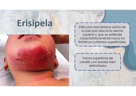 Erisipela Erisipela Infeccion bacteriana súbita de la