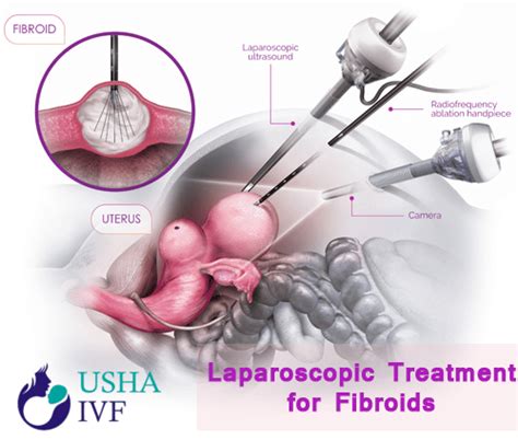 Laparoscopic Treatment For Fibroids At Usha Ivf