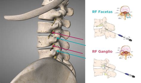 Radiofrecuencia Instituto Contra El Dolor Dr Trinidad