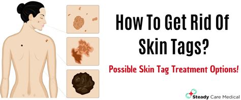 How To Get Rid Of Skin Tags? Possible Skin Tag Treatment Options ...