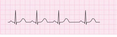 Emergency Med Exam 1 Arrhythmia Treatments Flashcards Quizlet