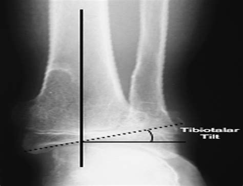 rebound  ankle valgus deformity  patients  hereditar