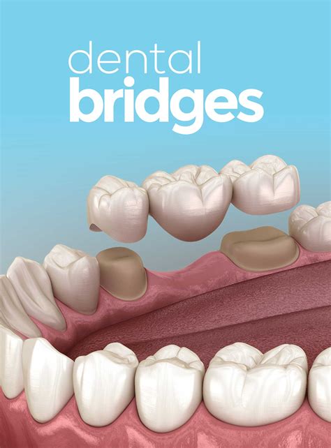 Dental Bridges In Costa Rica At America Dental Clinic