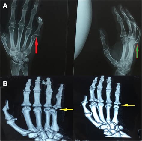 A X Rays Showed Dorsal Complex Metacarpophalangeal Joint Dislocation