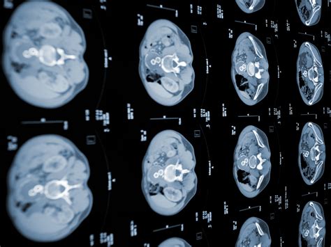 Breakthrough vaccine could help stop pancreatic cancer returning after