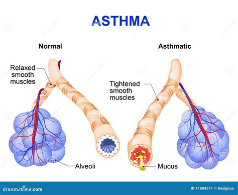 Asthma - Chronic Inflammatory Disease - Anatomy Royalty-Free Stock ...