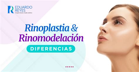 Diferencias Entre Rinoplastia Y Rinomodelación Eduardo Reyes