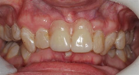 Upper And Lower Fixed Implant Bridges Class 2 Deep Bite Female