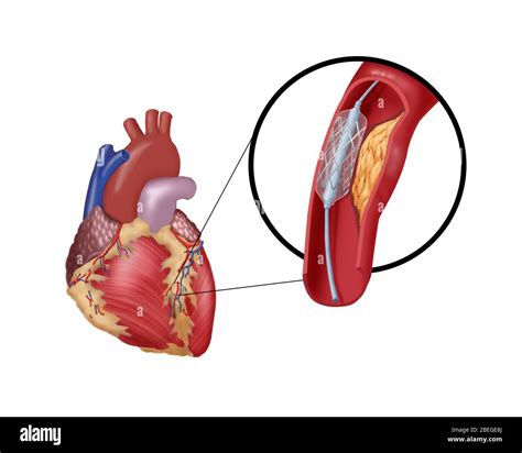 Angioplastia Con Stent De Fotograf A De Stock Alamy