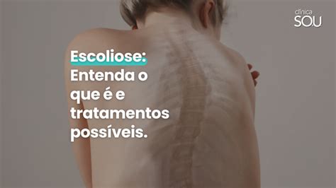 Escoliose Entenda O Que E Tratamentos Poss Veis Sou Cl Nica