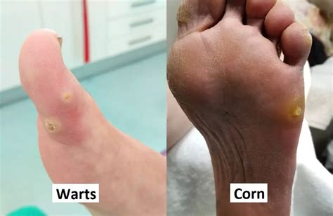 What S The Difference Between A Planters Wart And A Corn At Robert