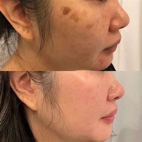 Cosmelan Peel System The Grand Medical Aesthetic Clinic