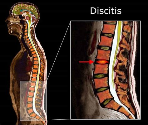 Discitis, discitis osteomyelitis, causes, symptoms, diagnosis & treatment