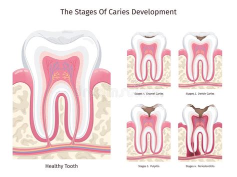 Etapas De Caries Progreso De Los Dientes De Decaimiento Humano