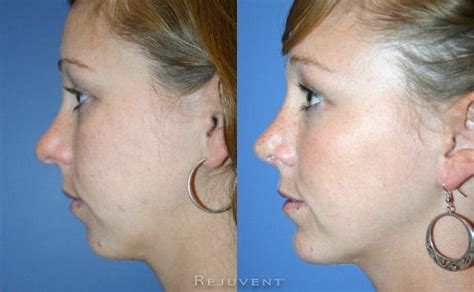 surgical chin augmentation   rejuvent scottsdale