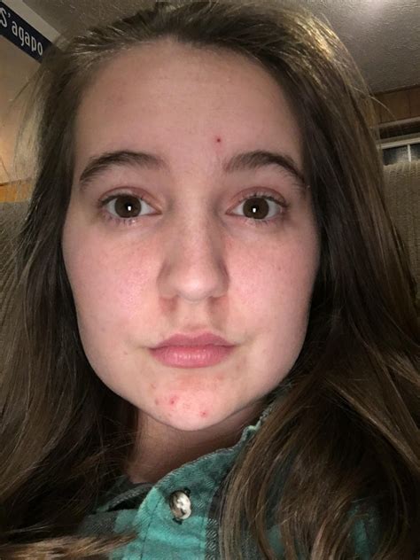 [Acne] I’ve had clear skin all my life. Until I had a mandatory birth