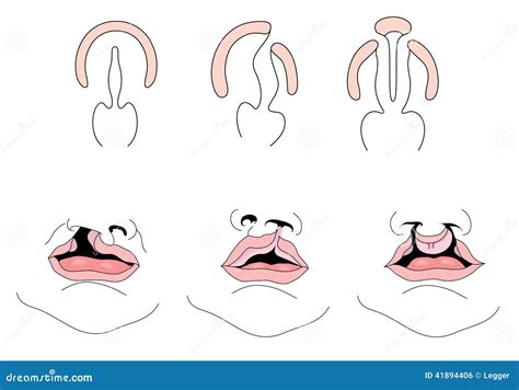 Drawing Of Cleft Palate And Cleft Lip Stock Vector Illustration Of