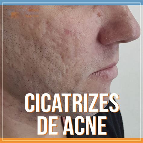 Tipos De Cicatrizes De Acne Conheça Os 3 Principais Clinica De Pele