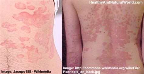 Natural Ways To Relieve Psoriasis