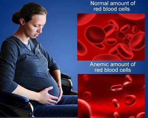 Anemia In Pregnancy Causes Prevention Symptoms Diagnosis Treatment