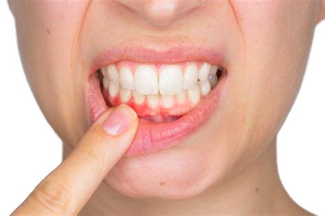 Qué es la piorrea Síntomas y tratamiento LG DENTAL