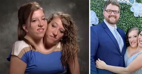 One-Half of The Conjoined Twins Got Married, and It Causes a Stir