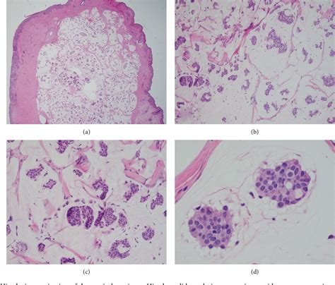 Figure 2 From Treatment Of Recurrent Primary Cutaneous Mucinous Carcinoma Of The Eyelid With