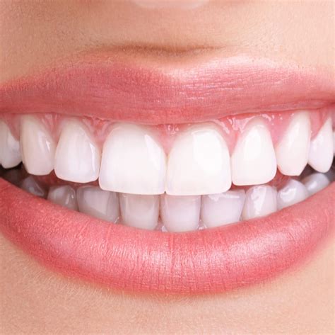 Veneers - Southern Dental