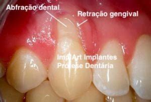 Retração Da Gengiva Causas - Quais as causas e tratamentos possíveis para a retração gengival? ImplArt