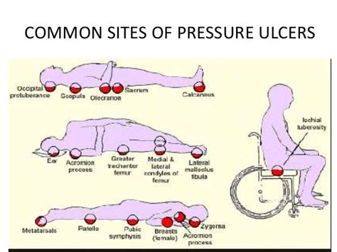 Pressure Ulcer Sites Diagram