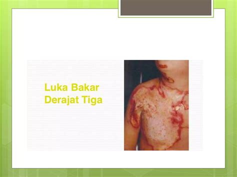 cara mengatasi luka bakar ringan 6