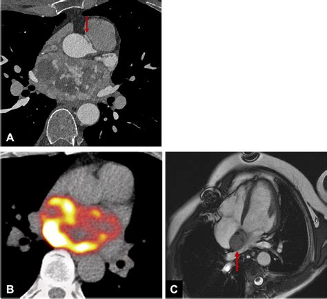 Multimodality Imaging Of Cardiac Paragangliomas Radiology