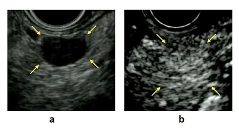 A B Mode Endoscopic Ultrasound Eus A Circular Hypoechoic Mass Is