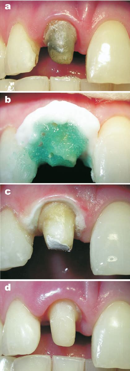 Root Canal Crown Color