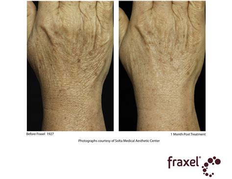 Fraxel Laser Folsom Dermatology Folsom Ca