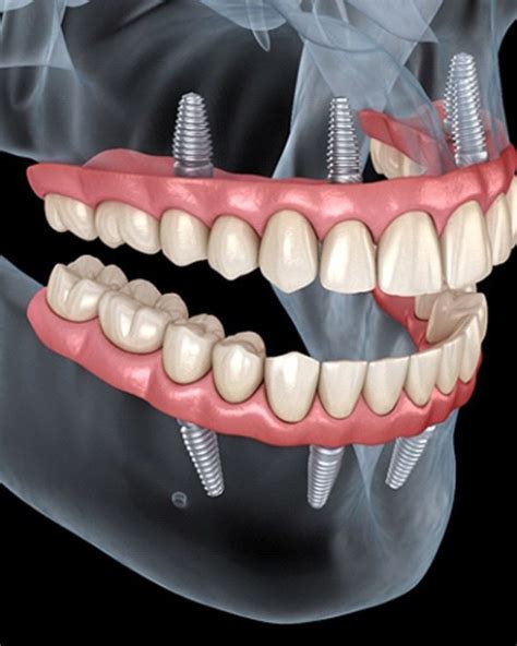 All On 4 Dental Implants Scotland Full Mouth Implants