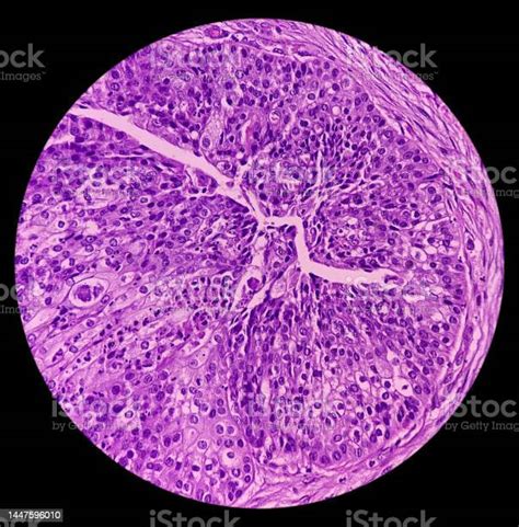 High Grade Mucoepidermoid Carcinoma Of Parotid Cyst Microscopic Show Parotid Tissue Features Of