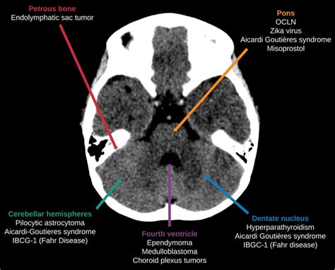 Common Causes Of Calcification Arising From The Posterior Fossa Download Scientific Diagram