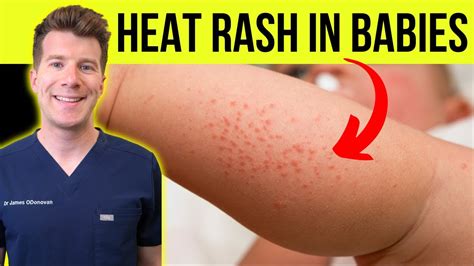 Can You Get A Heat Rash From A Fever At Doris Lewis Blog